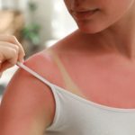 naturally prevent sunburn