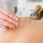 5 Benefits Of Acupuncture